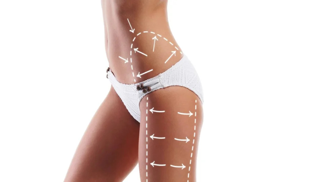 liposuctie