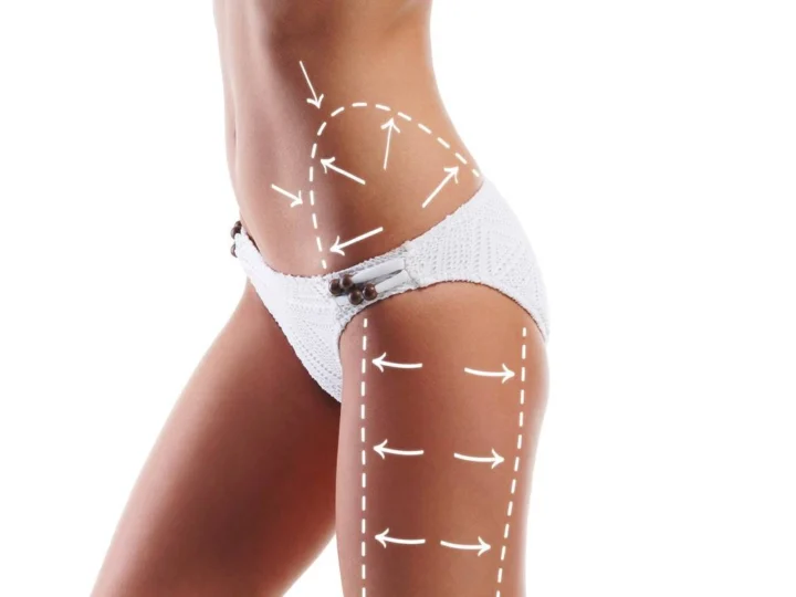 liposuctie