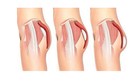 pozitionare implant fese Dr. Panturu