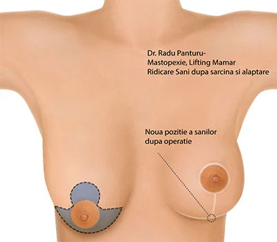 Lifting sani dupa nastere Dr. Panturu