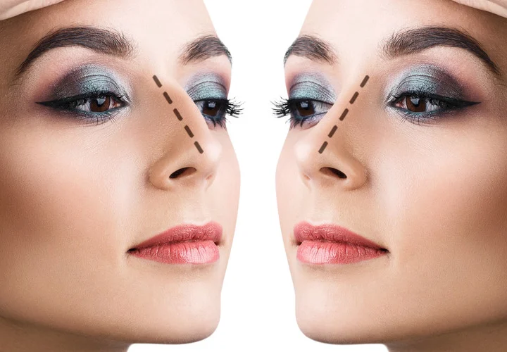 rinoplastie sfaturi