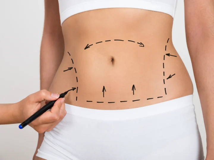 liposuctie abdominala