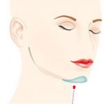 implant barbie dr panturu