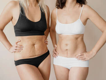 Cum poți scăpa de cicatrici?