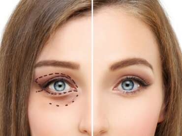 Blefaroplastia – tratamentul chirurgical pentru pleoape căzute