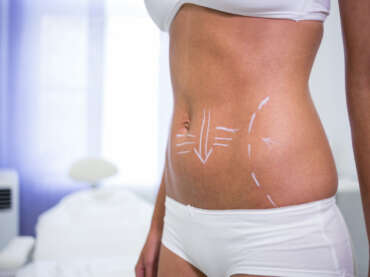 Ce este abdominoplastia, intervenția de remodelare completă a siluetei?