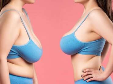 Sânii lăsați: cum poate fi corectată această problemă estetică?