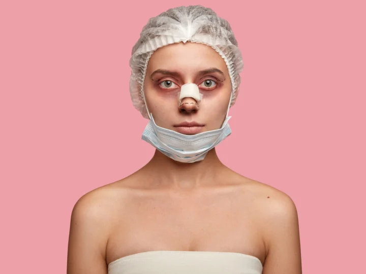 Vânătăi după rinoplastie? Iată cum grăbești procesul de vindecare