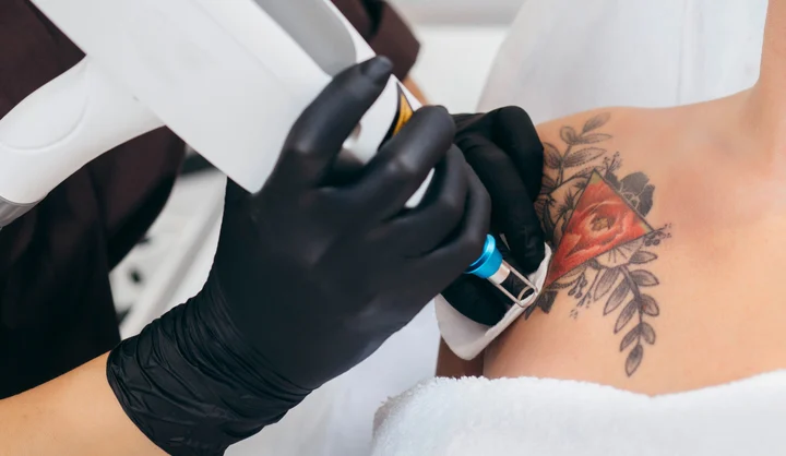 Despre procedura de eliminare a tatuajelor și machiajului semipermanent cu laser