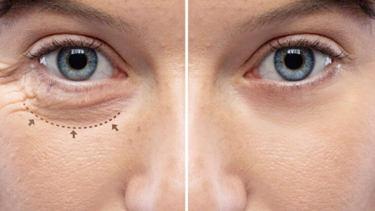 4 Alternative nechirurgicale ale blefaroplastiei chirurgicale