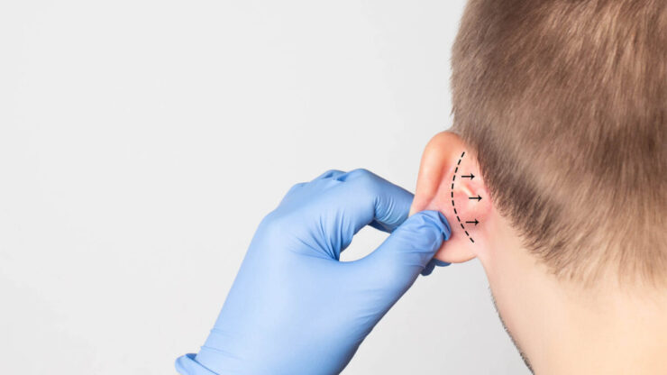 Urechi clăpăuge: un complex de care poți scăpa cu otoplastie