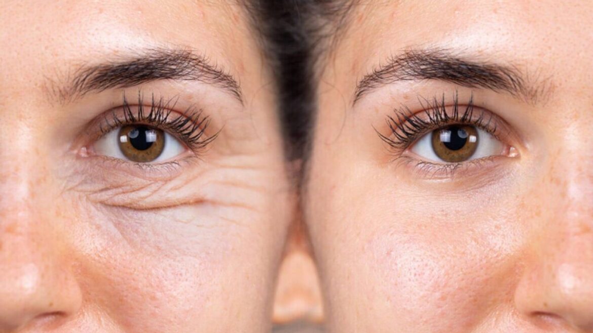 4 Alternative nechirurgicale ale blefaroplastiei chirurgicale