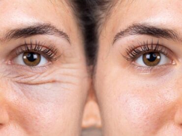 4 Alternative nechirurgicale ale blefaroplastiei chirurgicale