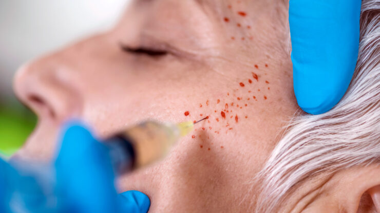 Vrei să încerci terapia vampir dar îți este frică de ace? Iată ce trebuie să faci!