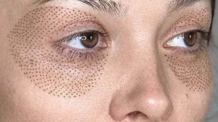 4 Alternative nechirurgicale ale blefaroplastiei chirurgicale